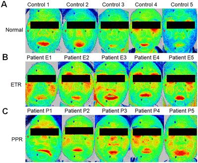 Exploring the efficacy of laser speckle contrast imaging in the stratified diagnosis of rosacea: a quantitative analysis of facial blood flow dynamics across varied regions